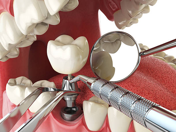 Best Emergency Dental Care for Broken or Chipped Teeth in Eddyville, IA